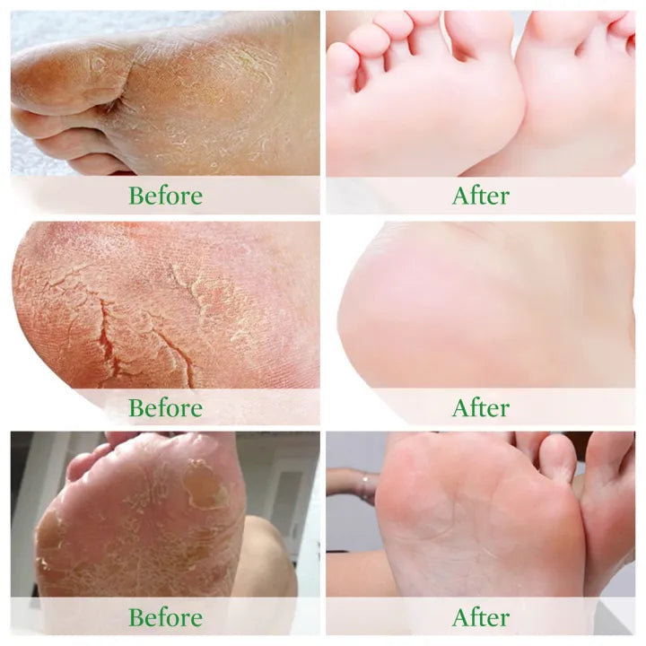 EXFOLIATING FOOT PEEL MASK ( BUY 1 GET 1 FREE )