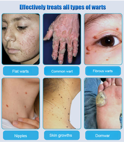 LANISKA Wart Care Topical Spray